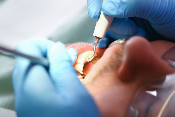 Best Emergency Root Canal Treatment in Clarkston, GA