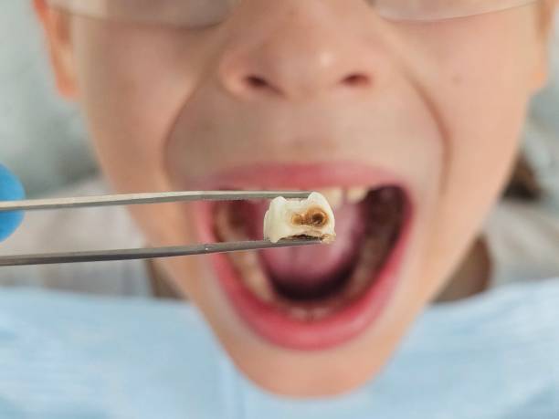 Best Emergency Dental Care for Broken or Chipped Teeth in Clarkston, GA