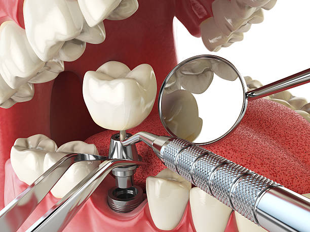 Best Urgent Care for Lost Fillings or Crowns in Clarkston, GA